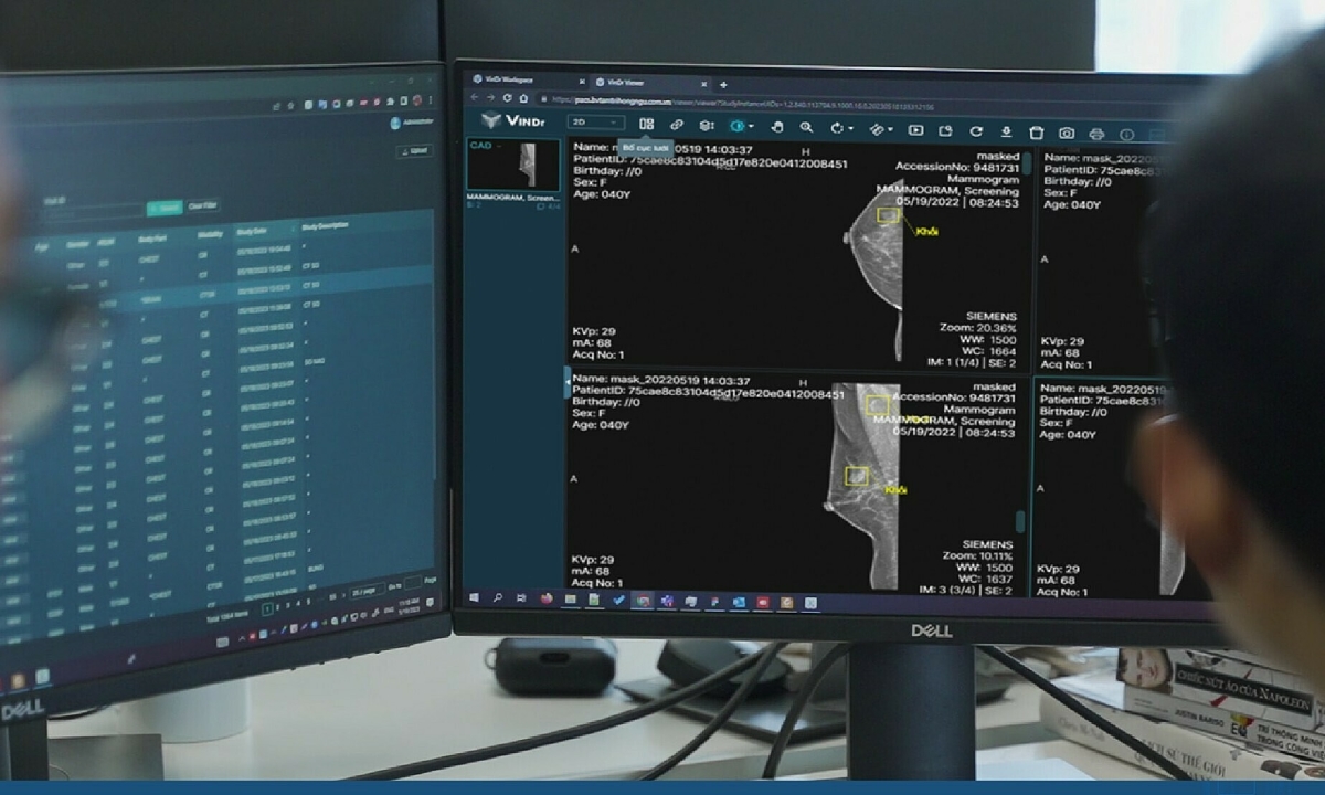 AI chẩn đoán X-quang tuyến vú của Việt Nam rộng cửa vào Mỹ