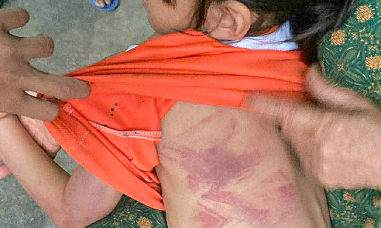 Bé gái lớp 2 bị bạn nam đánh bầm tím người