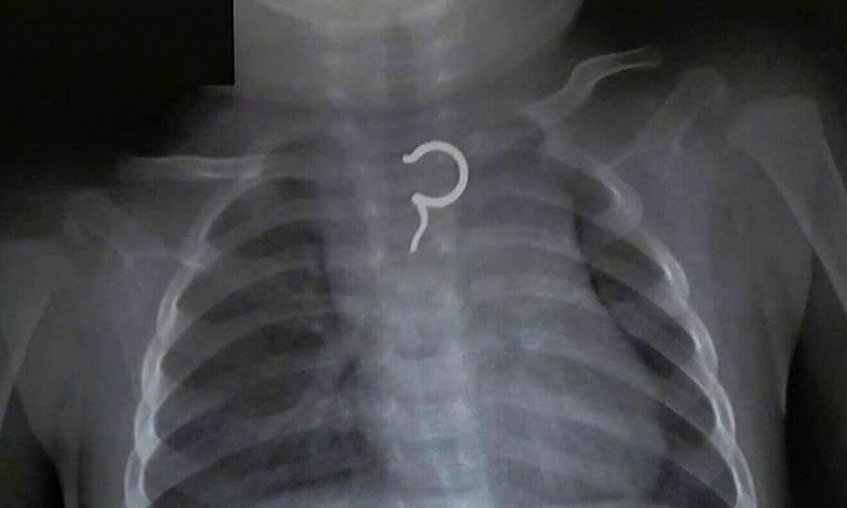 Gắp khuyên tai mắc ở thực quản bé gái 8 tháng tuổi
