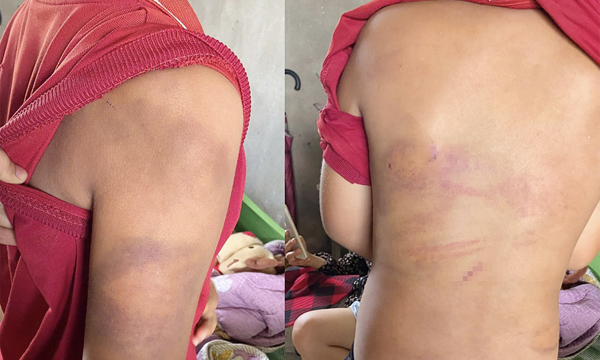 Công an làm việc với ông bố dùng roi tre đánh con bầm tím