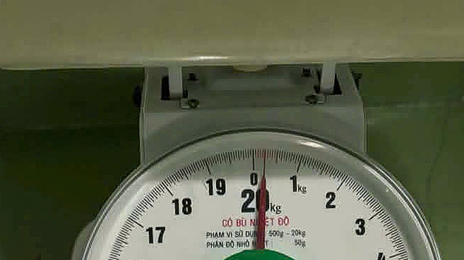 Bé gái 5 tuổi tắc ruột bởi khối tóc gần 250 g